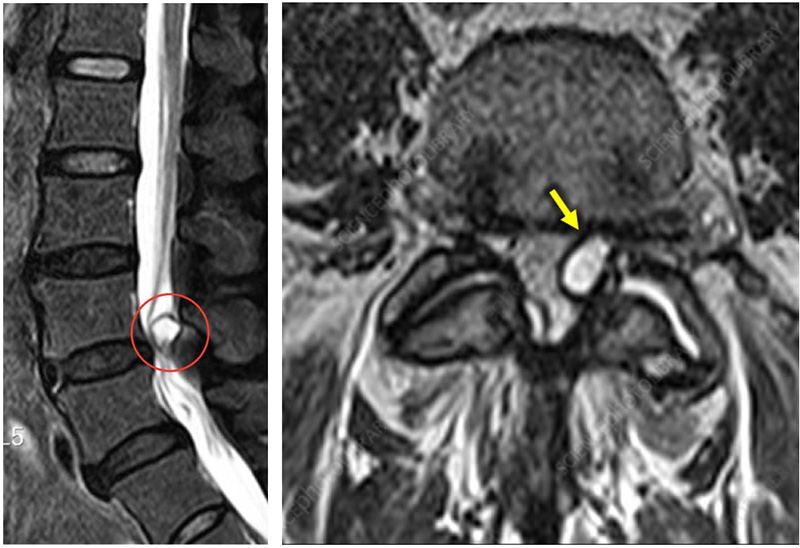 À esquerda Ressonância Magnética corte sagital mostrando cisto sinovial. À direita, corte axial, evidenciando a compressão da raíz nervosa na coluna lombar.