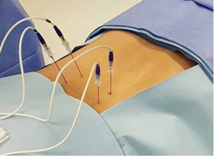 Imagem de agulhas conectadas a um gerador externo de radiofrequência, utilizado para realizar a rizotomia por radiofrequência, um procedimento minimamente invasivo que neutraliza o nervo causador da dor crônica na coluna.